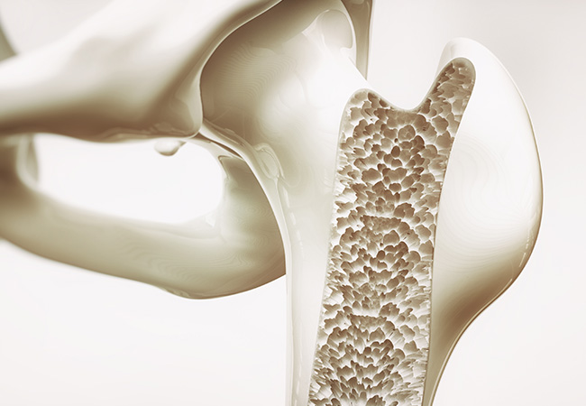 骨粗鬆症とは